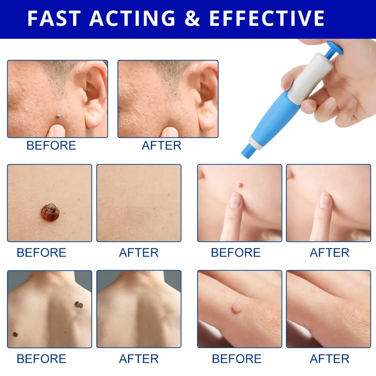 1 Set Auto Skin Tag Remover 2-8mm Band Painless Mole Wart Skin Tag Removal Pen Wart Dot Corn Treatments Body Facial Beauty Tool