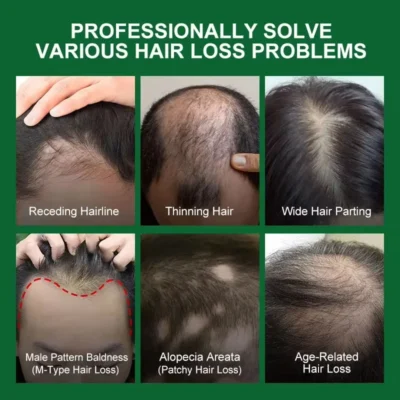 Fast Hair Growth Serum Spray Anti Hair Loss Prevent Baldness Scalp Treatment Repair Roots Beauty Health Hair Care For Men Women