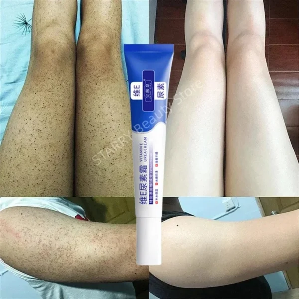 Curing Keratosis Pilaris Chicken Follicle Skin Repair Cream Body Dark Spot Remove Whitening Smooth Moisturize Skincare Body loti
